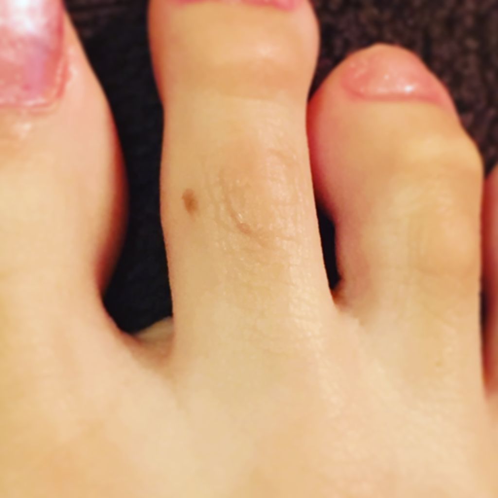 ピンク色が好きな人ヽ(*´∀`)ノのblog 足の指ホクロ除去レポート