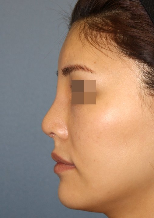 D 前額プロテーゼ 鼻中隔延長術 他院鼻プロテーゼ入れ替え術 眉間プロテーゼ手術後2週間の経過写真 プリモ麻布十番クリニック美容形成外科医のブログ D 前額プロテーゼ 鼻中隔延長術 他院鼻プロテーゼ入れ替え術 眉間プロテーゼ手術後2週間の経過写真 プリモ麻布十番クリニック美容形成外科医のブログ