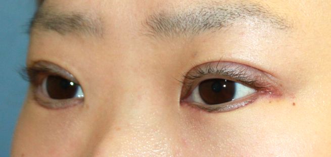 C 上下逆さまつ毛手術後1週間の経過写真 プリモ麻布十番クリニック美容形成外科医のブログ