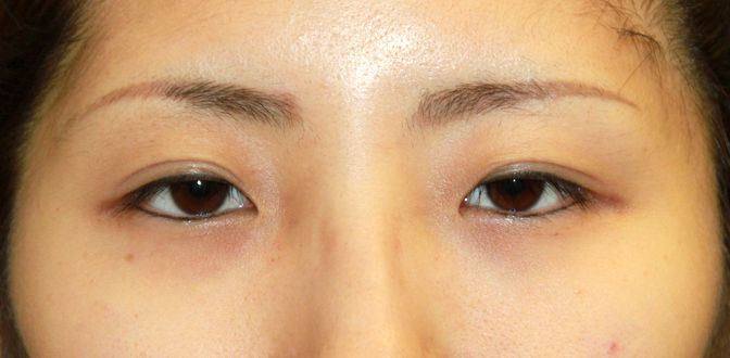 L 結膜側からの眼瞼下垂手術 埋没法による重瞼術後6ヶ月の経過写真 プリモ麻布十番クリニック美容形成外科医のブログ