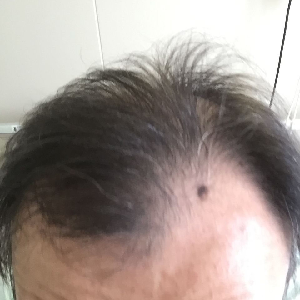 閲覧注意 急性骨髄性白血病の闘病生活 26そいつは突然やって来る 白血病から回復 そして食べ歩き 閲覧注意 急性骨髄性白血病の闘病生活 26そいつは突然やって来る 白血病から回復 そして食べ歩き