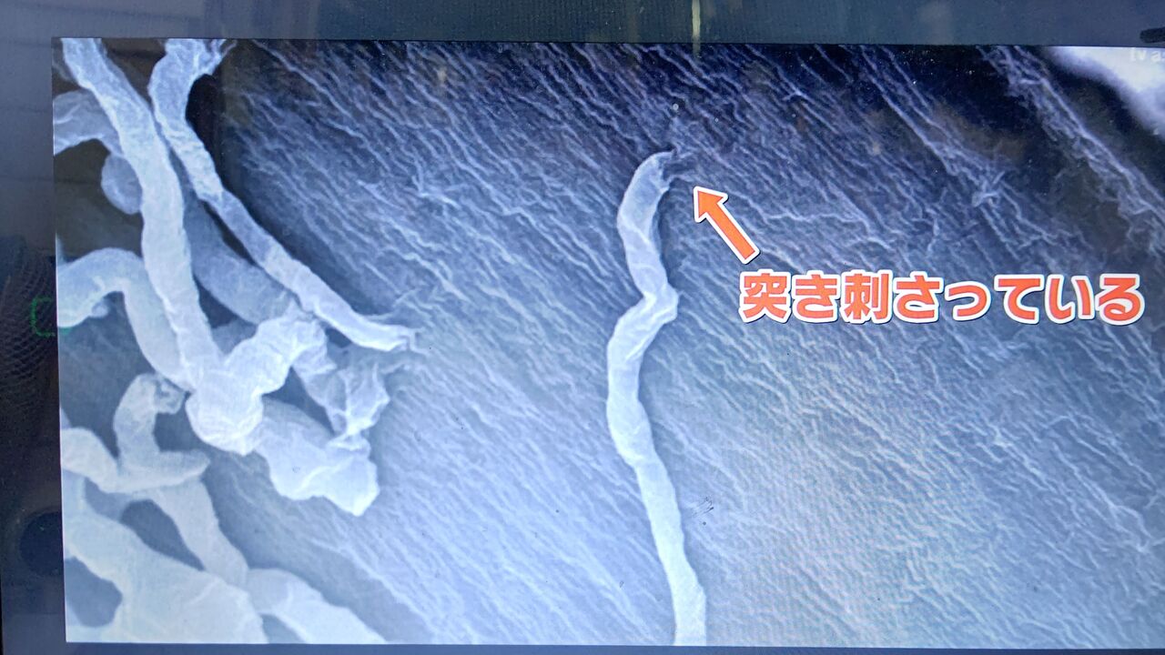 プラーク 溶かす 血管