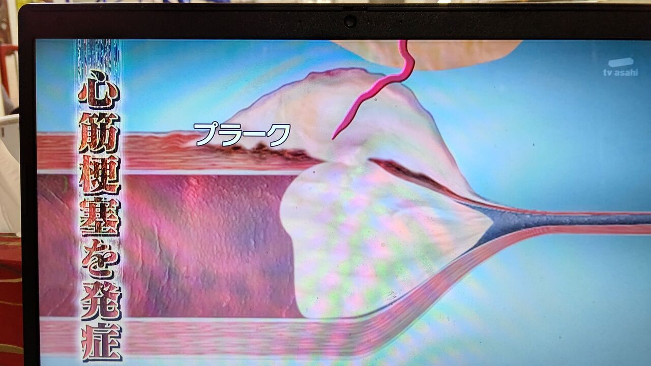 プラーク 溶かす 血管