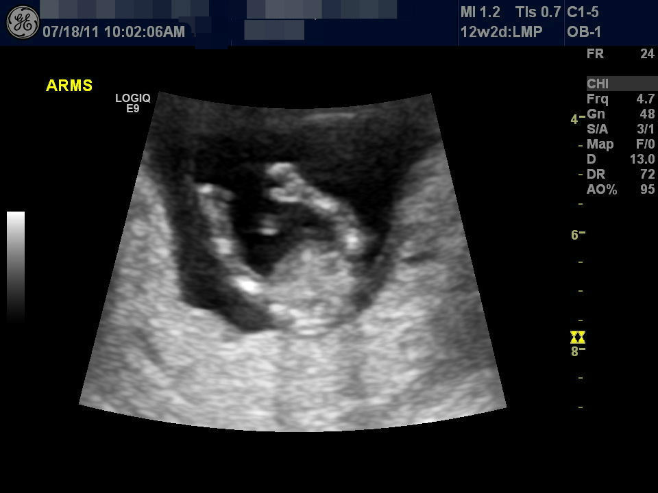 妊娠 出産 アメリカ 妊娠4ヶ月 12 15週