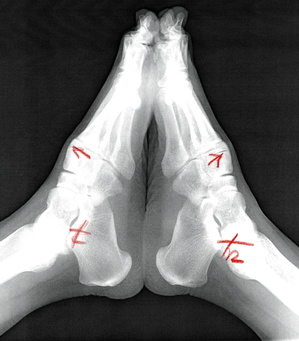 足の外科レントゲン