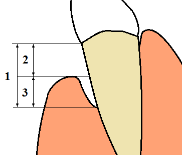 Periodontal_terms_diagram_gingival_recession