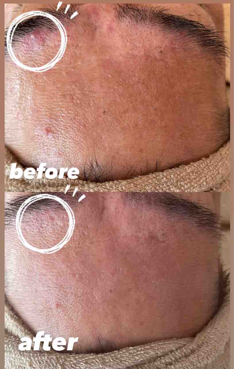 嬉しい結果に ニキビと毛穴がお悩みのお客様のビフォーアフター Private Salon Rejuvena