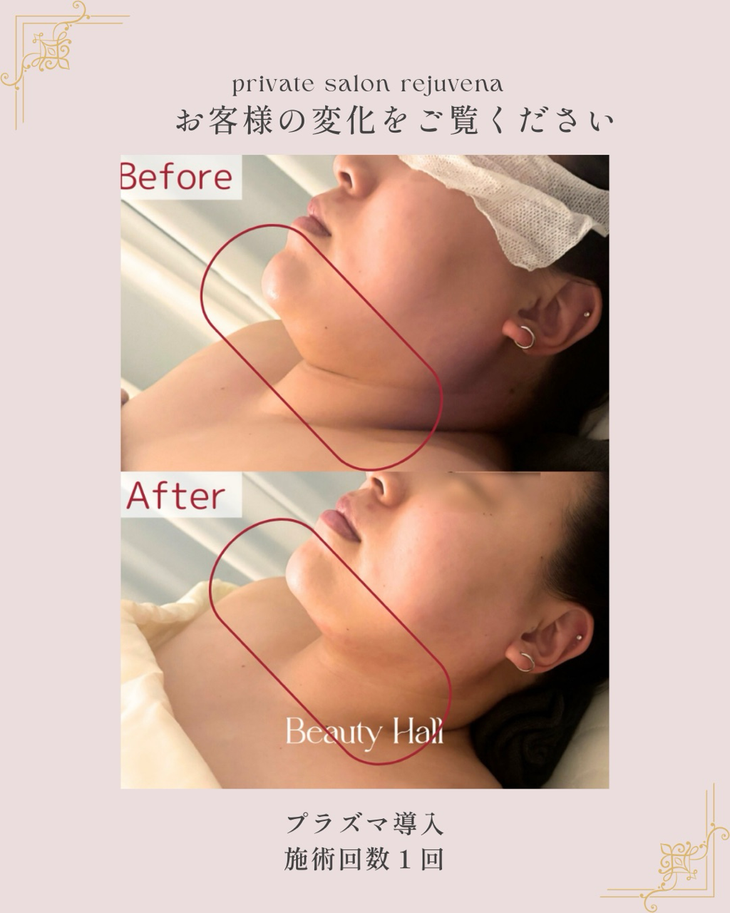 脂肪分解で簡単らく痩せ！】 : 【フェイシャルエステ・肌管理サロン