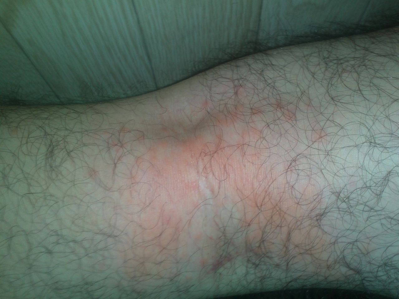 日記 膝裏が酷い炎症で痒い オダろぐ