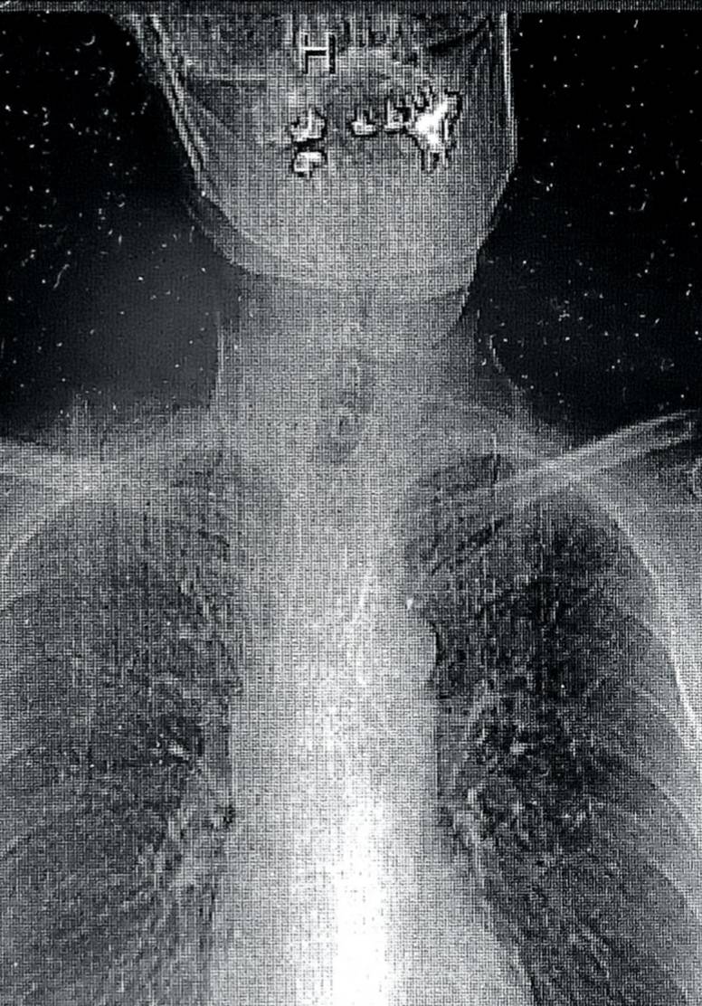 ガーーーーン 口腔底癌の転移 再発death ｲﾉﾏｰの ﾆｯｷﾝﾀﾏ