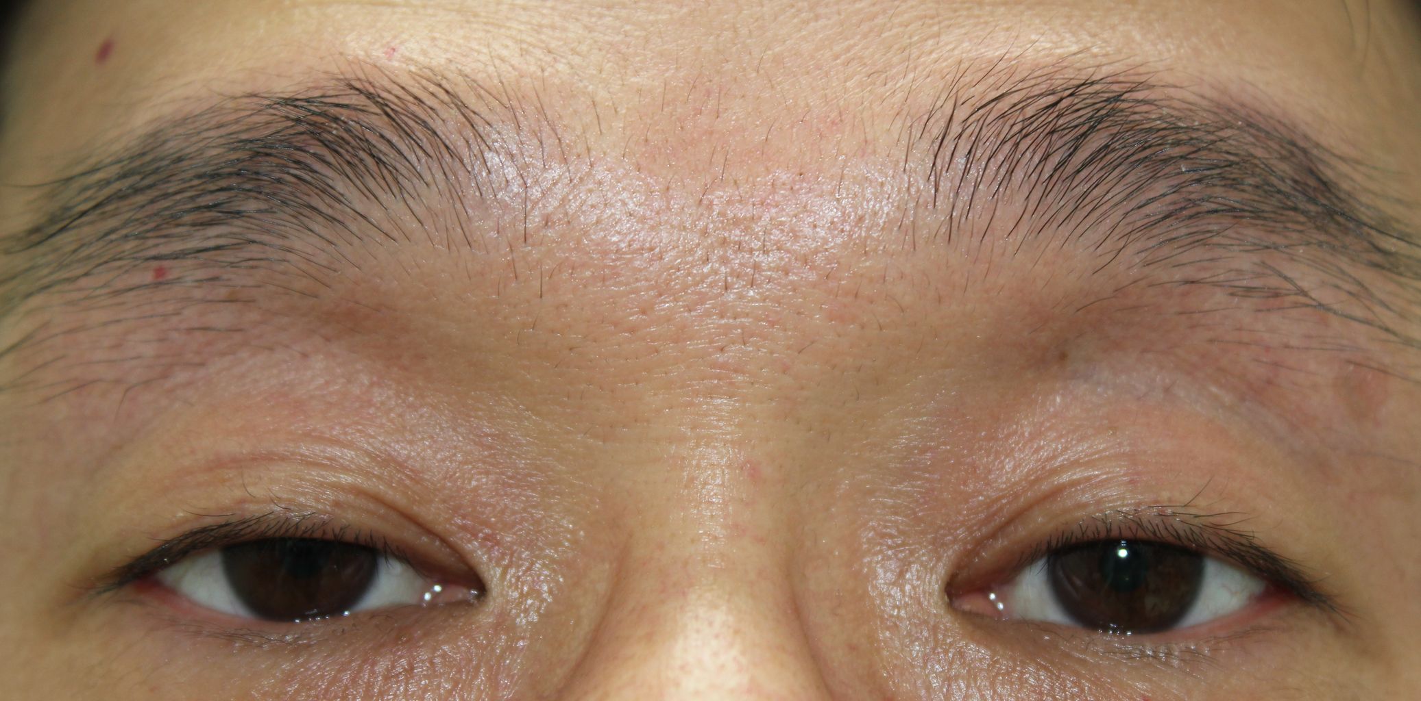 眼瞼下垂 40代 男性 経結膜眼瞼下垂手術 眼瞼下垂とアートメイクの緒方眼科クリニック 大田区蒲田駅近く