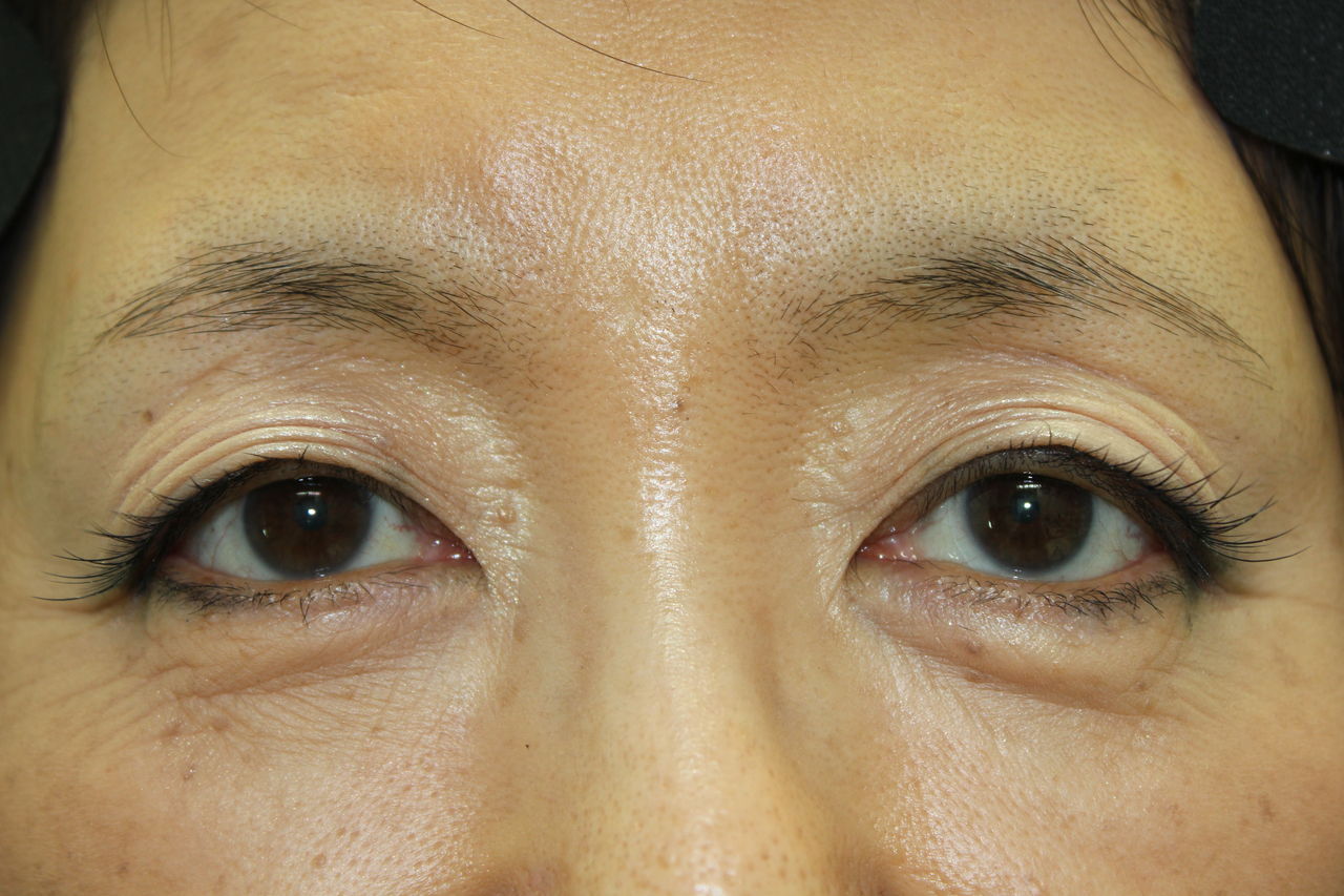 アートメイク 涼しい目元に 眼瞼下垂とアートメイクの緒方眼科クリニック 大田区蒲田駅近く