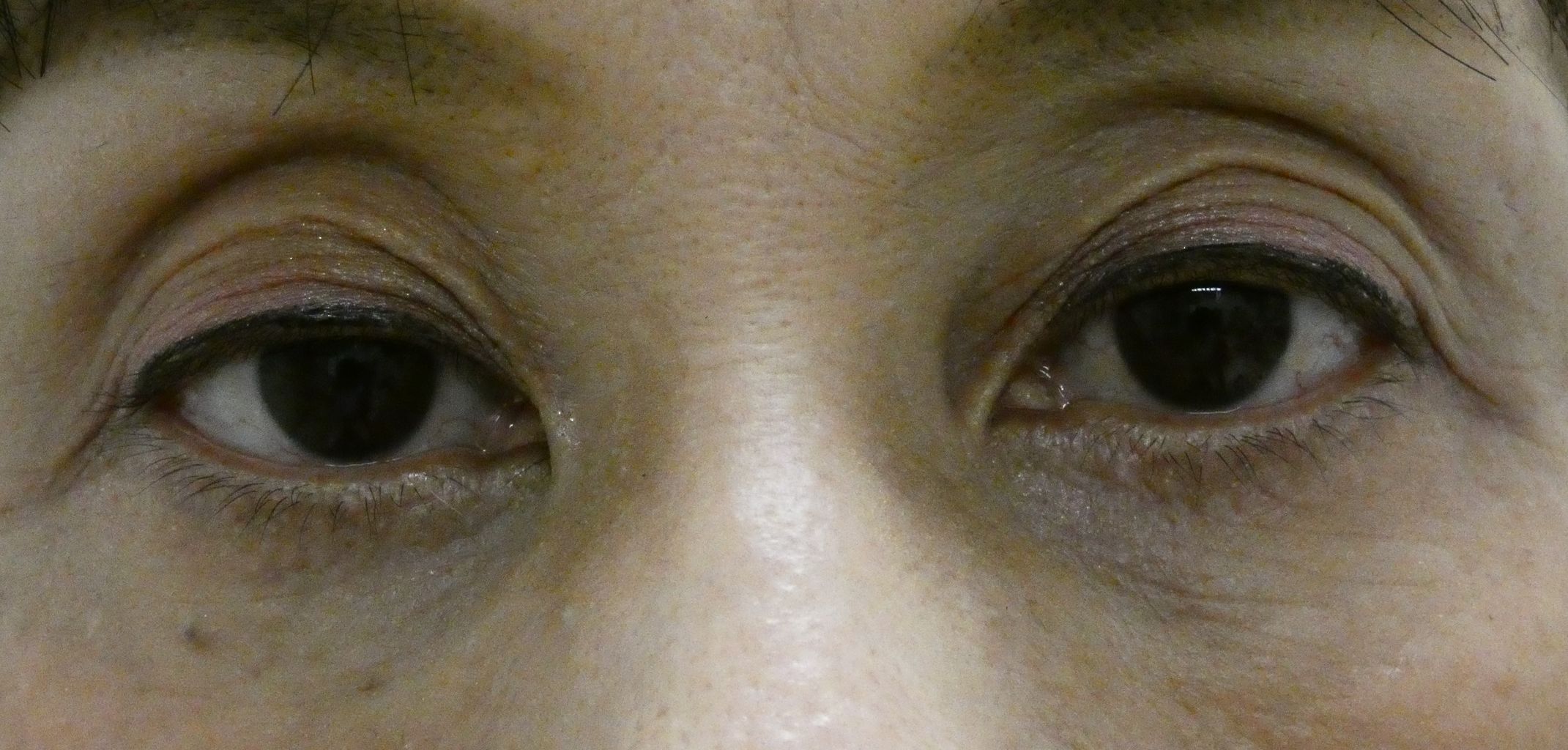 経結膜眼瞼下垂手術 50代女性 眼瞼下垂とアートメイクの緒方眼科クリニック 大田区蒲田駅近く