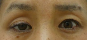 術後2