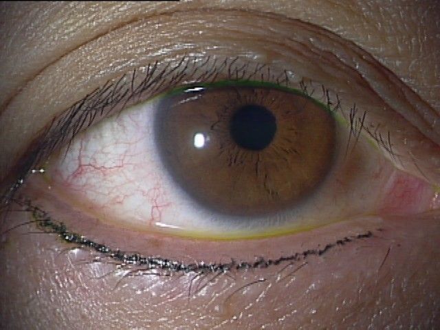 アートメイク アイライン 料金の改定 眼瞼下垂とアートメイクの緒方眼科クリニック 大田区蒲田駅近く