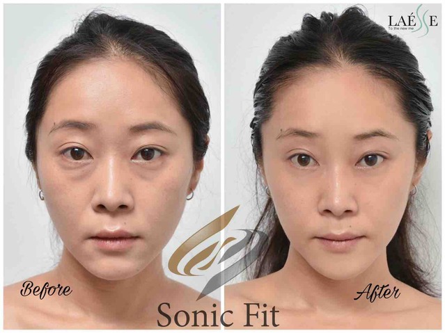 Laesse 医療関係者 痩身専門 bangkok バンコク