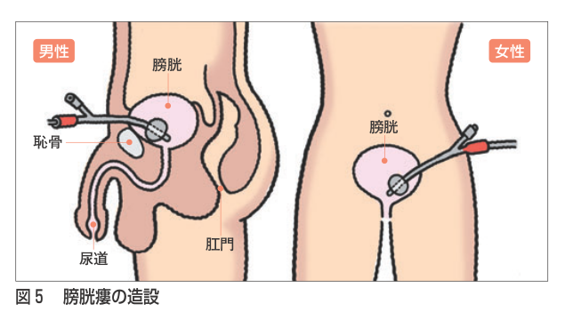 膀胱 タンポナーデ