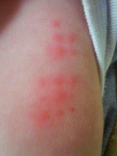 Bcgその後 お日記