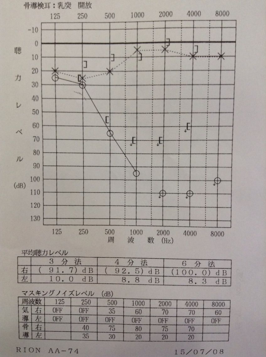 11年目の聴力検査結果 突発性難聴を発症して 11年目の聴力検査結果 突発性難聴を発症して
