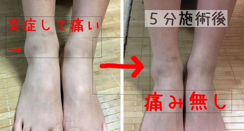 捻挫1-3
