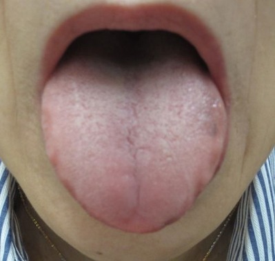 20121226舌表