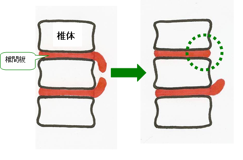 椎間板ヘルニア