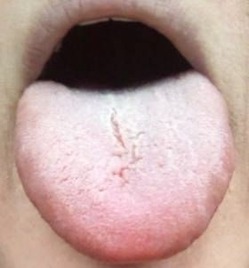 20140218舌表