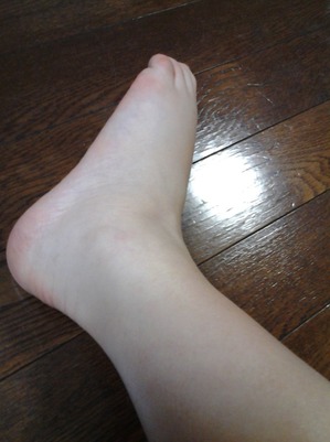 20150428漢方薬服用前の足