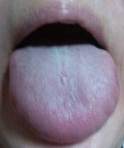 20140720舌表