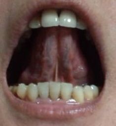 20140720舌裏
