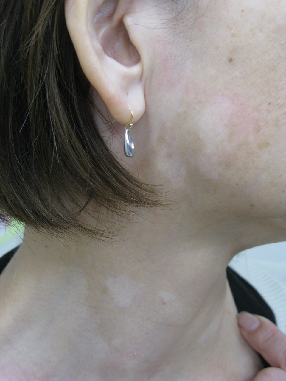 レサトールsrを服用3年目に尋常性白斑が発症し 中止後顕著に白斑が薄くなりました 木室ミヱ子の漢方薬