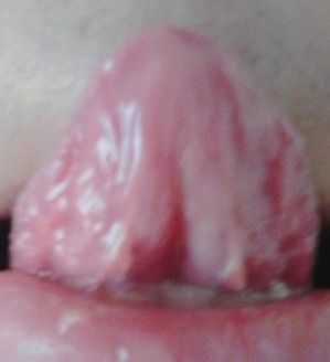 20151206舌の裏