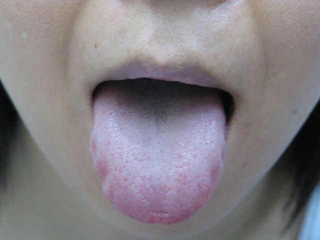 2010年7月2日舌表 肌正常