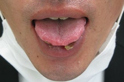 20120327舌表