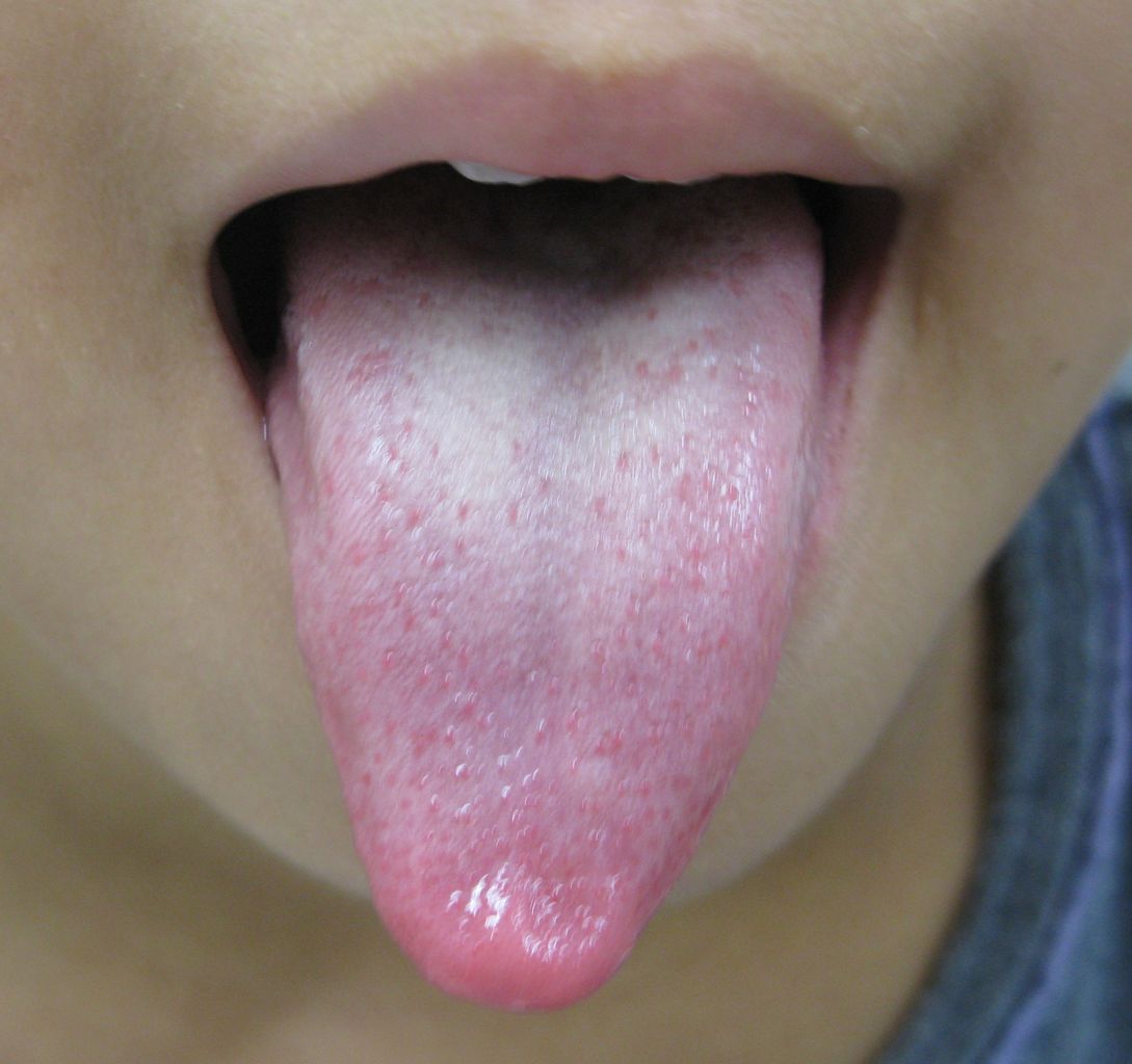 木室ミヱ子の漢方薬: おしりの湿疹が漢方薬できれいに正常肌に戻った写真です。 - livedoor Blog（ブログ）