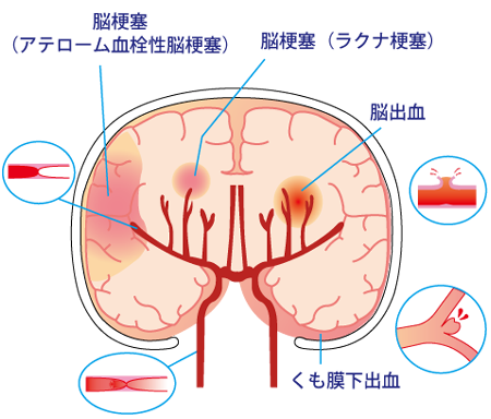 漢方薬 舌には病気のサイン 脳血管障害のシグナル 木室ミヱ子の漢方薬