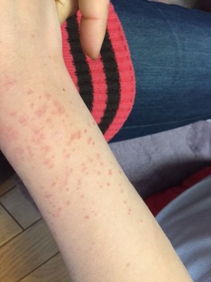 20150311足首からふらはぎにかけて