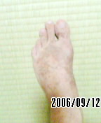 9/12左足痛風