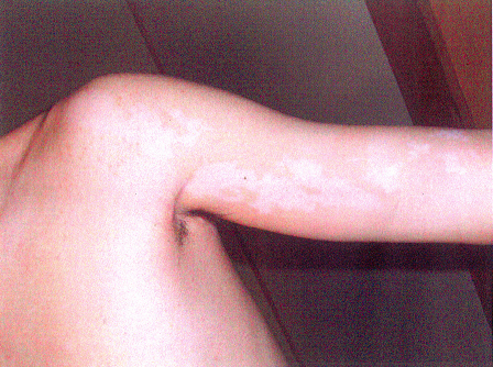 漢方薬服用後上腕部白斑2010年10月19日