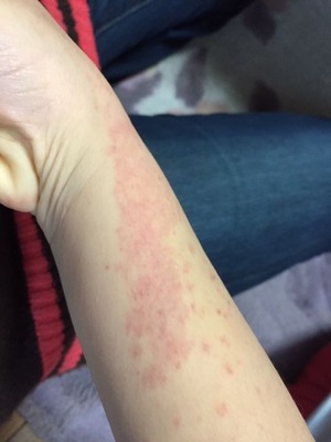 20150311手の紫斑