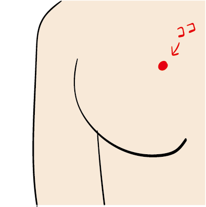 オカン乳腺炎になる 乳腺炎の症状 だいごろうの1日 Powered By ライブドアブログ オカン乳腺炎になる 乳腺炎の症状 だいごろうの1日 Powered By ライブドアブログ