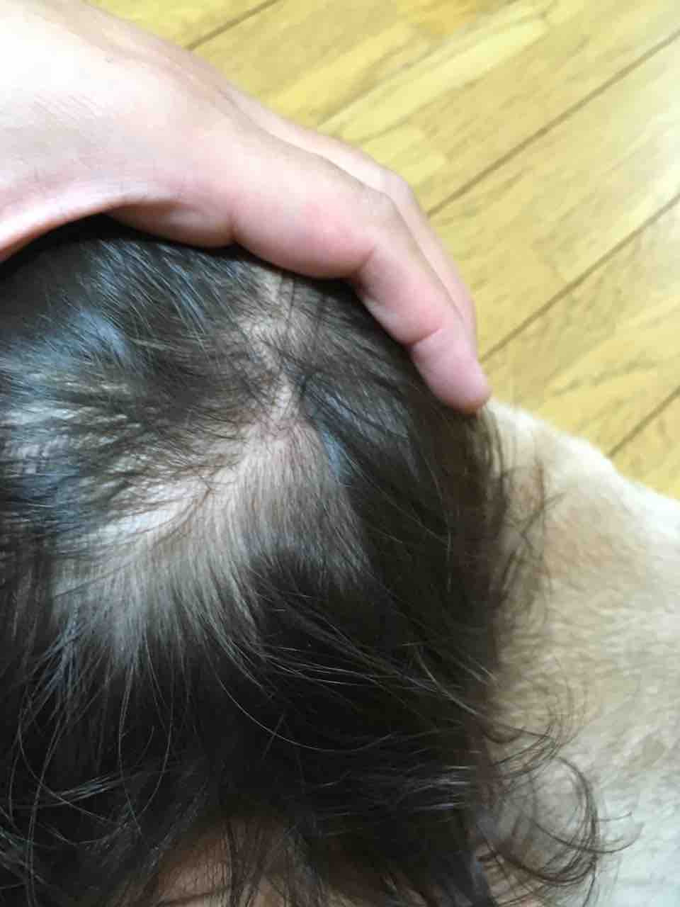 ウンナ母斑 その後 岡山にゃんこ ウンナ母斑 その後 岡山にゃんこ