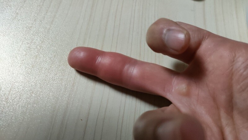 イラガに刺されたら早めの対処が大事 痛みを残さない秘訣はお湯 ひまチュンの機械ブログ