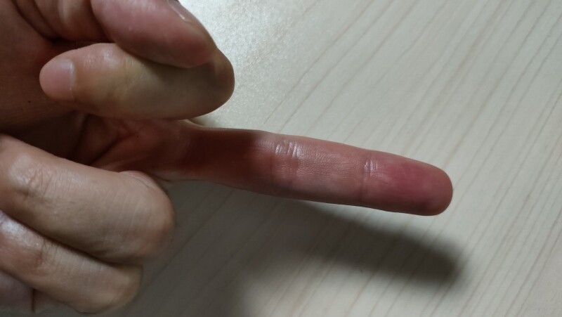 イラガに刺されたら早めの対処が大事 痛みを残さない秘訣はお湯 ひまチュンの機械ブログ