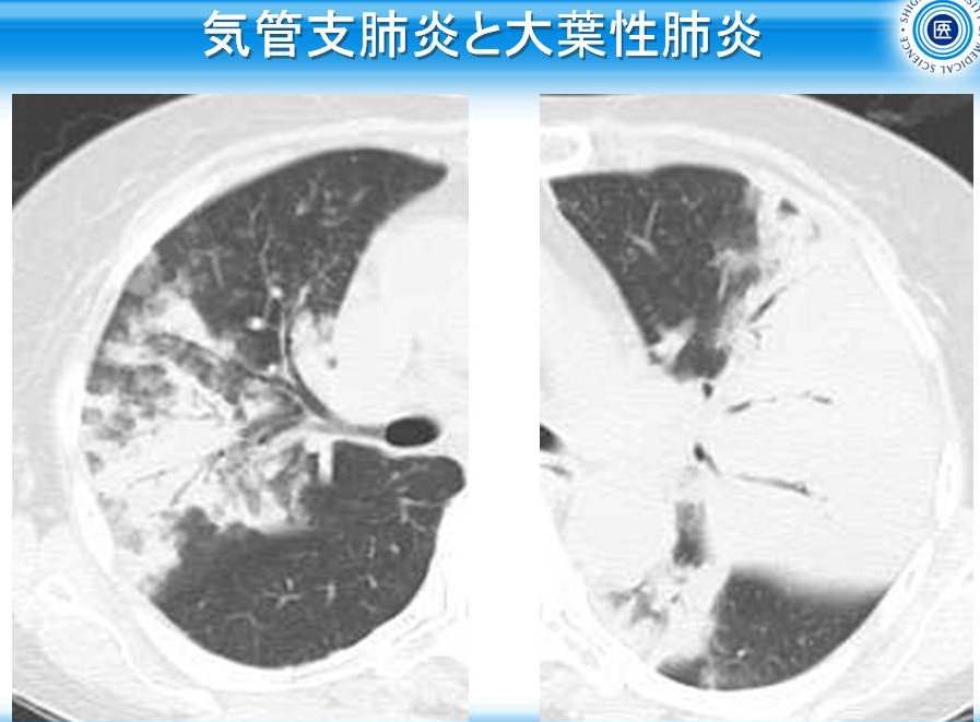 色々な肺炎 奥田洽爾 診療医学