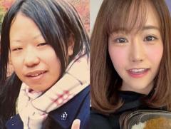 【整形美女】「整形への執着でなんとか生きていた」400万円の手術で女性が得られたものとは？