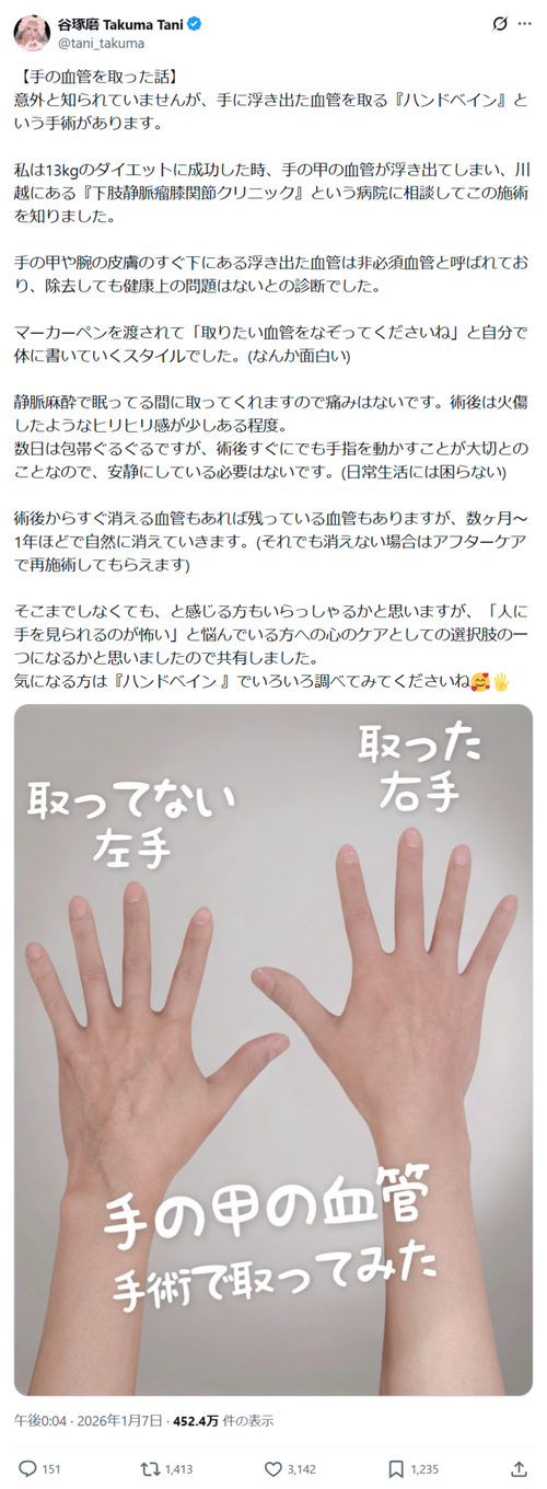 【悲報】男さん、手の血管を取ってしまうｗｗｗｗ