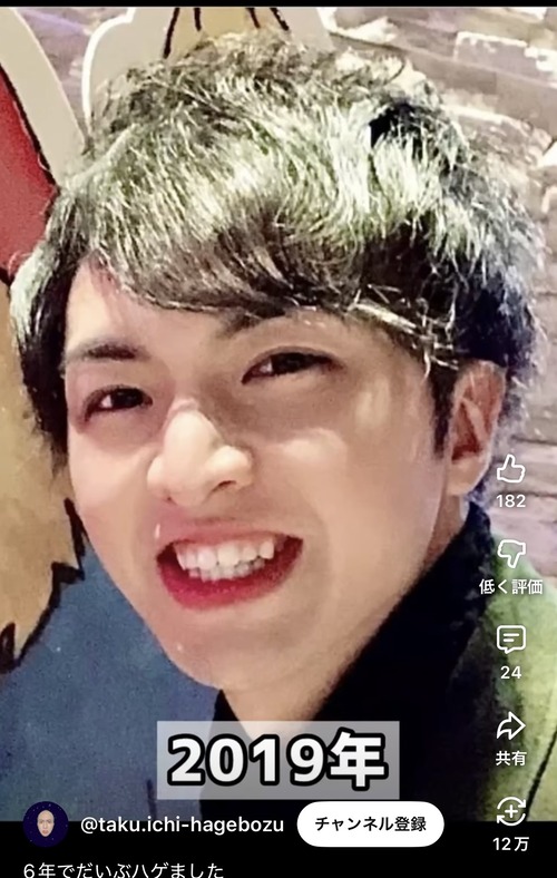 【画像】イケメンがハゲた結果ｗｗｗｗ