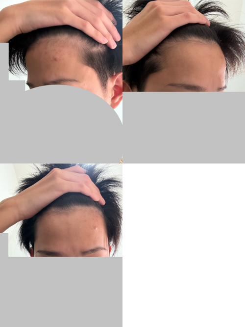 【画像】知恵袋民「高校一年生です。コレってハゲてますか？またはハゲ来てますか？」