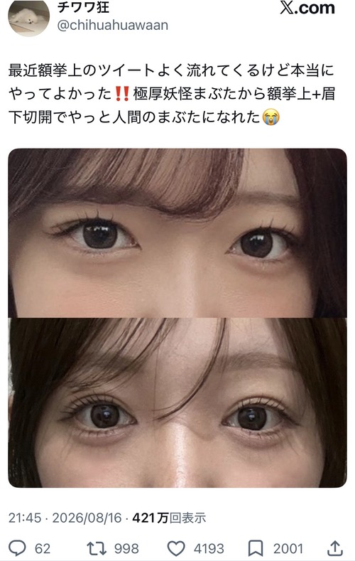 【画像】美容系女子、遂に「人間のまぶた」を手に入れて泣くｗｗｗｗ
